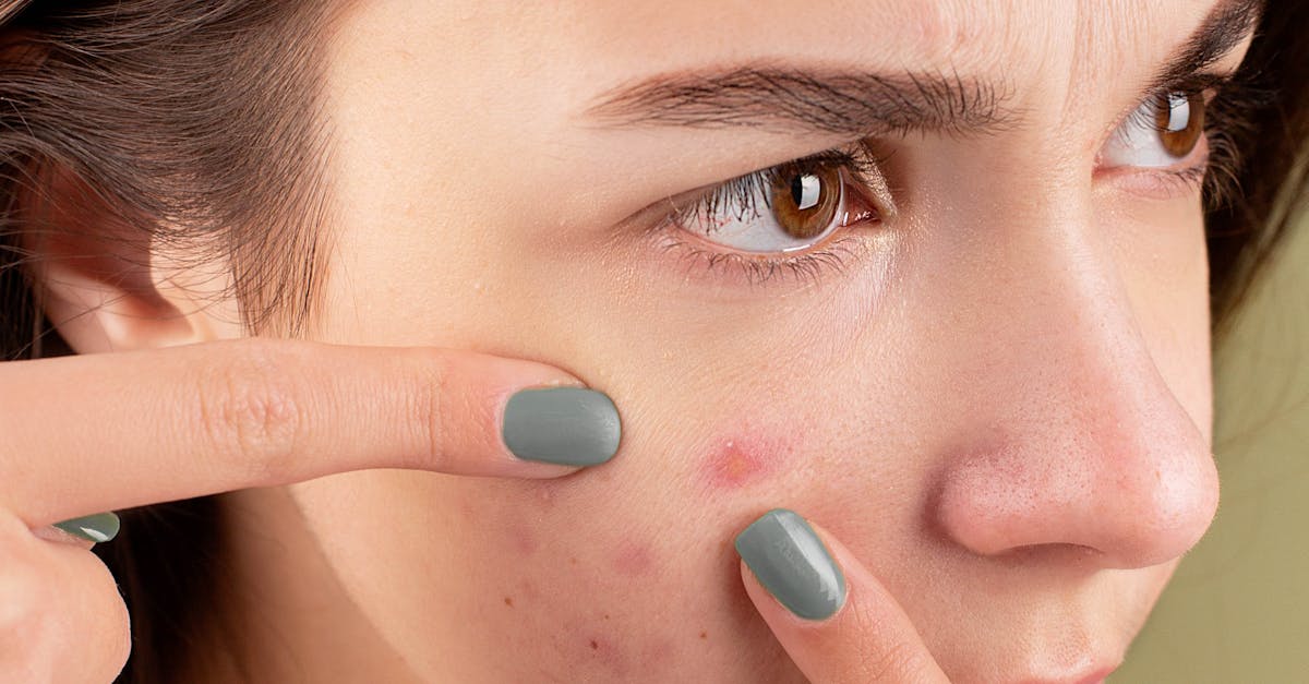 Acne e Gen Z: aumentano i casi nel mondo
