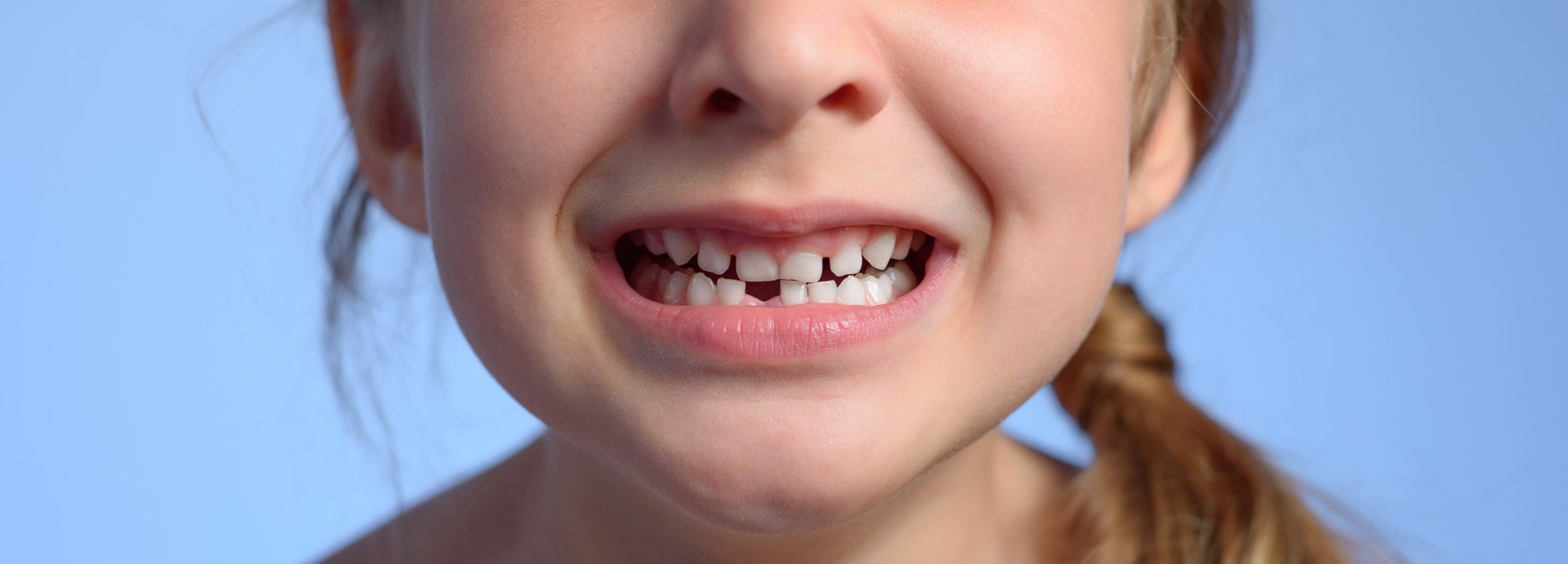 Adolescenti e sorriso: quando mancano i denti