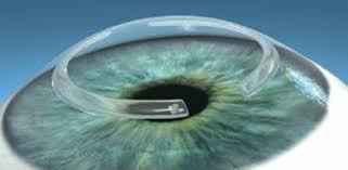 Cheratocono: salvare la vista senza trapianto si può