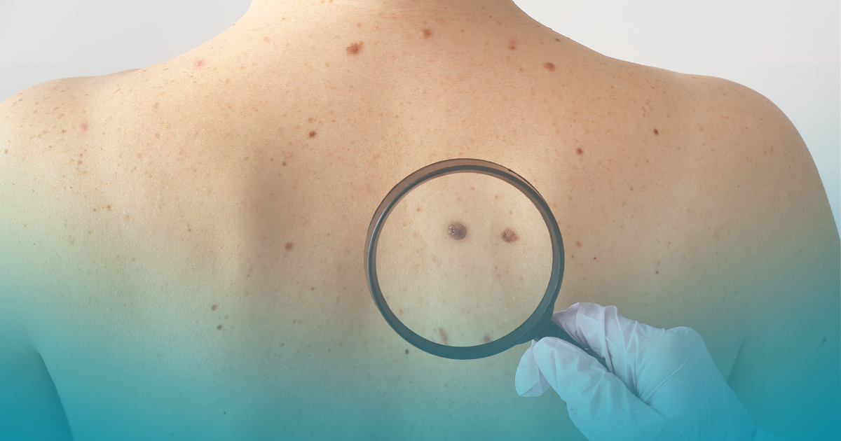 Melanoma: per prevenirlo esami genetici e sorveglianza cutanea